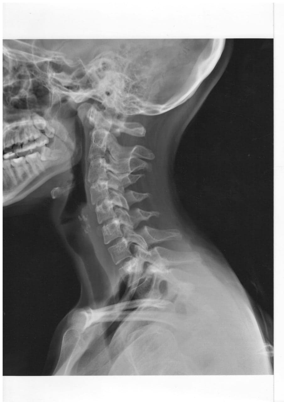Osteolysis in the cervical spine