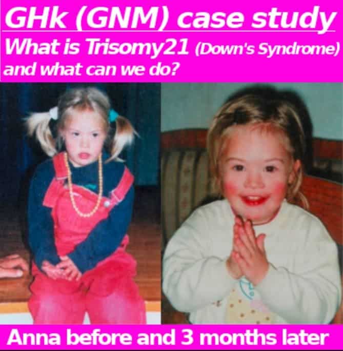 The Case of Anna, Down Syndrome