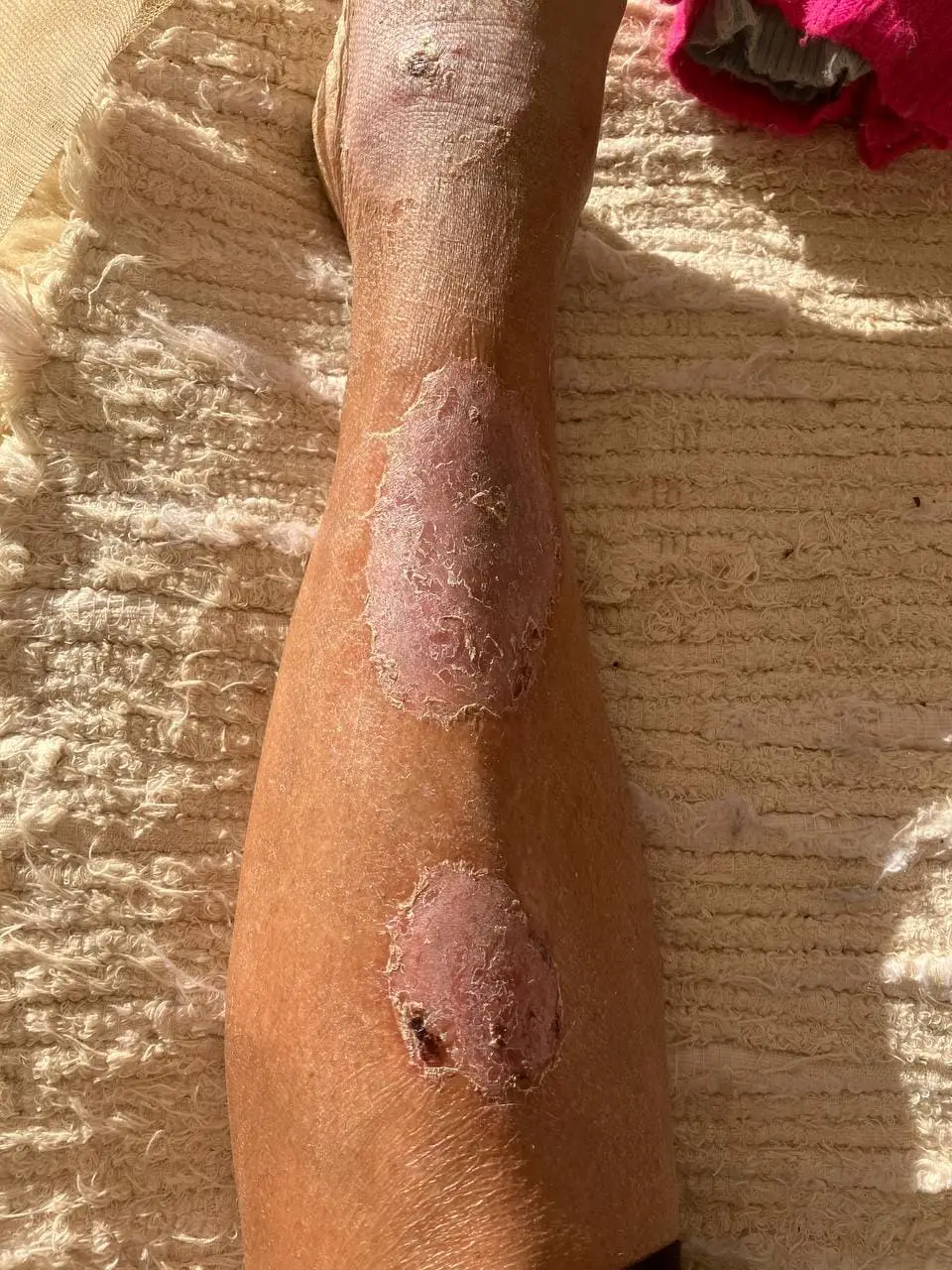 Leg ulcers after a two-month healing phase.jpg