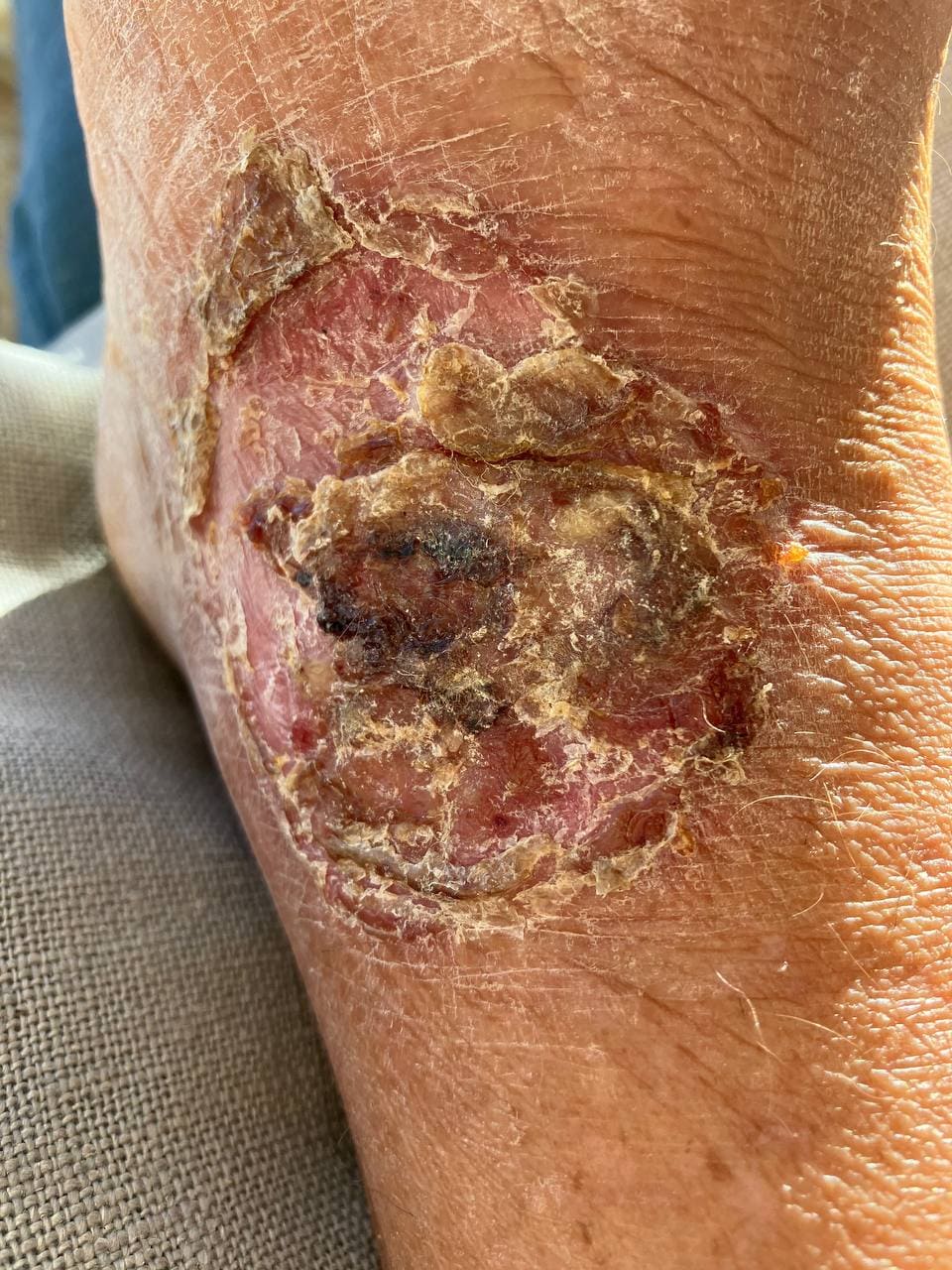 Leg ulcers: squamous epithelium and connective tissue in hanging healing.