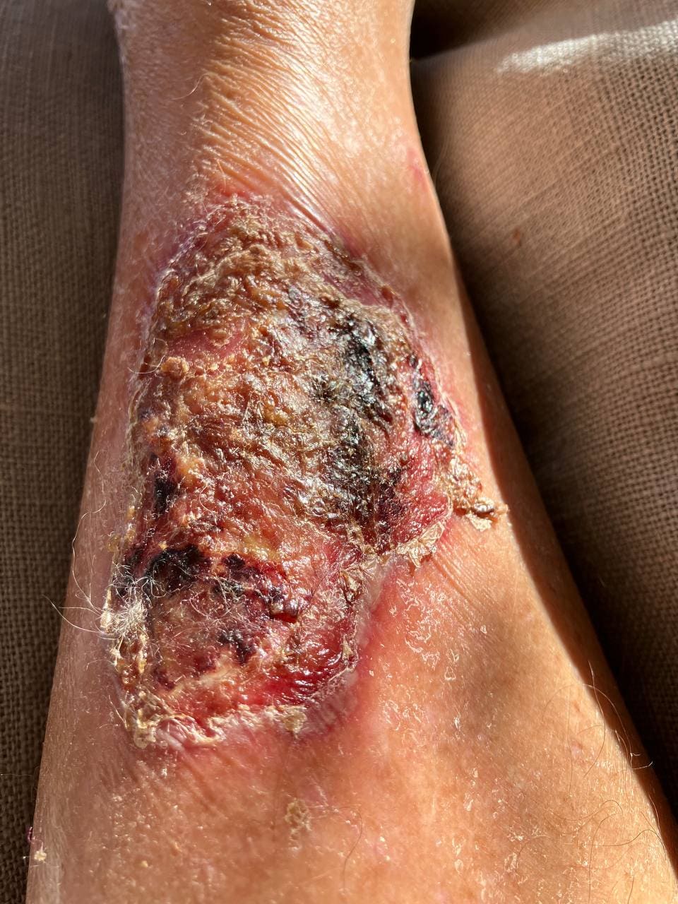 Leg ulcers: squamous epithelium and connective tissue in hanging healing