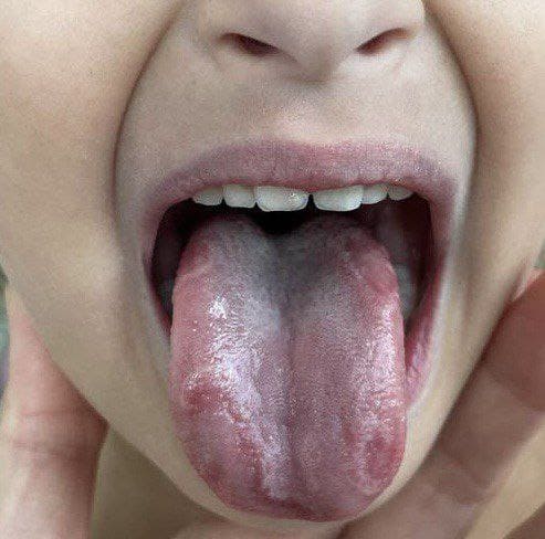 Tongue mouth sore ulcers